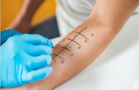 Reazione allergica nella ricostruzione unghie